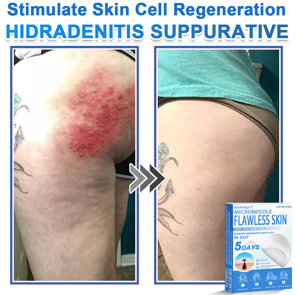 🎁 SkinPrikyn™ 2-in-1 Microneedle & Hydrocolloid Patch | Raised Moles,Acne,  Flat Warts & Skin Tags Remover | Improves Wrinkles, Scars & Blemishes | Invisible Pimple Patches for Face & Body | 144 Count